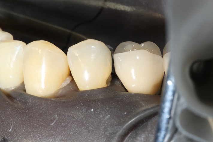 Larry Fujioka #21 buccal view pre-op