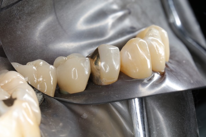 Larry Fujioka #21 finish buccal view