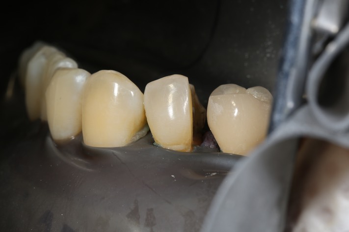 Larry Fujioka #21 prep buccal view