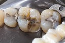 Larry Fujioka #3 amalgam removal