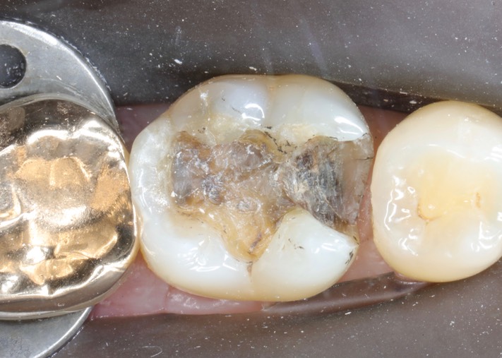 Larry Fujioka #30 caries removal