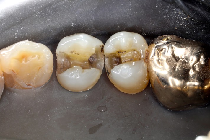 Larry Fujioka #4-5 amalgam removal