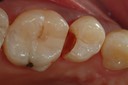 Larry Fujioka #4 caries removal