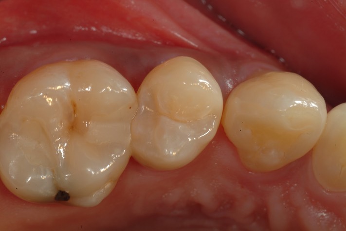 Larry Fujioka #4 pre-op