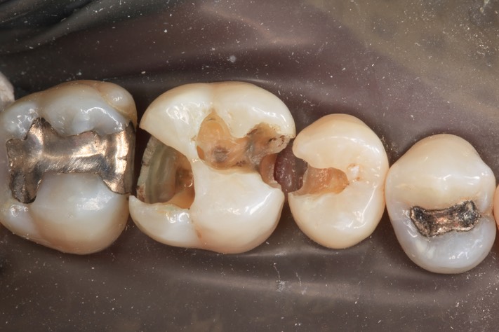 Larry Fujioka #13-14 caries removal