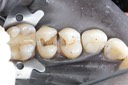 Mark Chun #12-13 caries removal