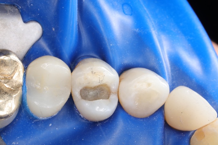 Mark Chun #12 amalgam removal