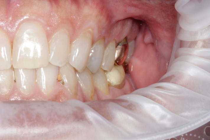 Mark Chun #13 pre-op 