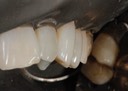 Mark Chun #13 prep buccal view