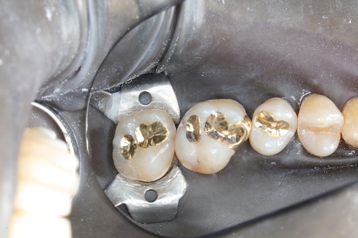 Mark Chun #13,14,15 casting try in