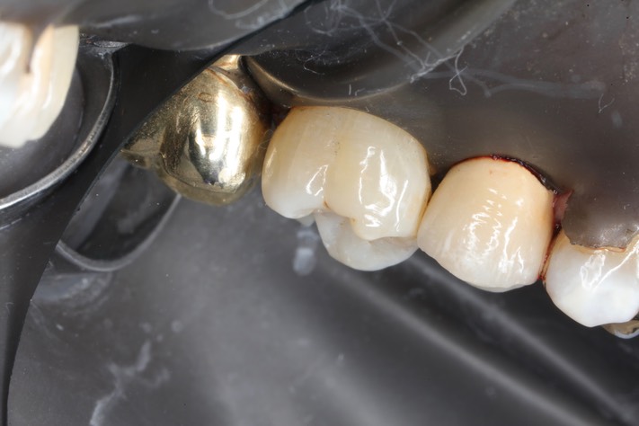 Mark Chun #14 buccal view