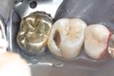 Mark Chun #14 caries removal