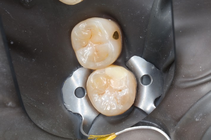 Mark Chun #17 pre-op