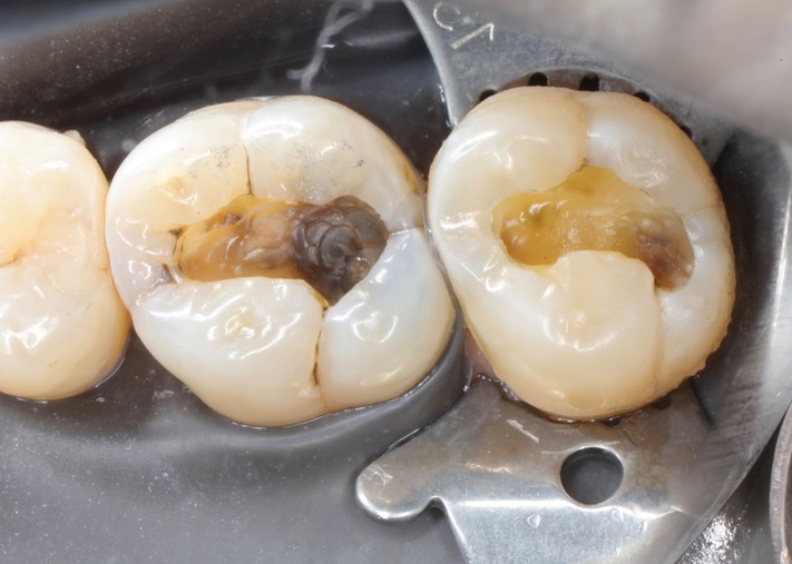 Mark Chun #2 & 3 amalgam removal
