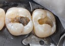Mark Chun #2 & 3 caries removal