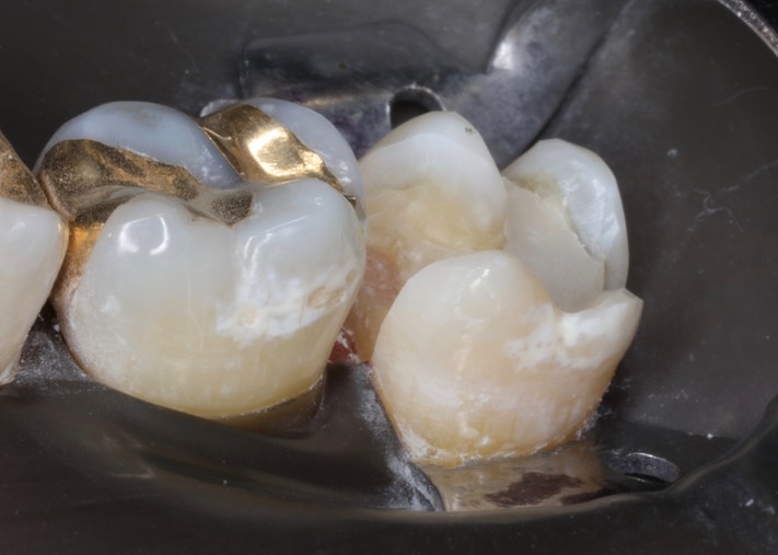 Mark Chun #2 prep buccal view