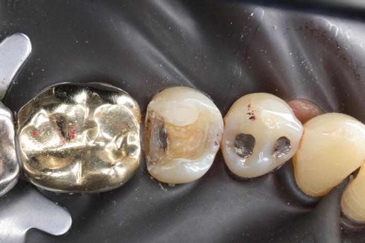 Mark Chun #29 amalgam removal