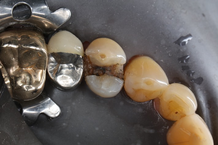 Matt Dodson #12 amalgam removal