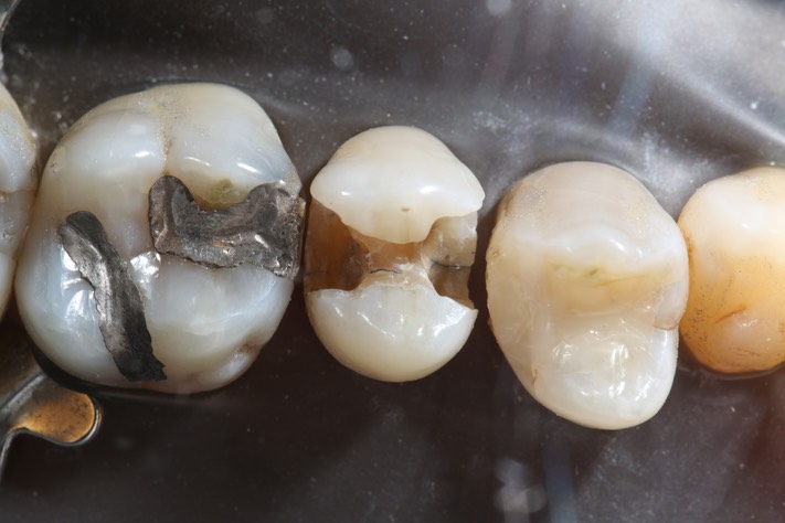 Matt Dodson #13 caries removal