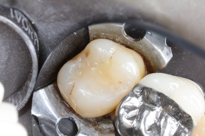 Matt Dodson #15 pre-op