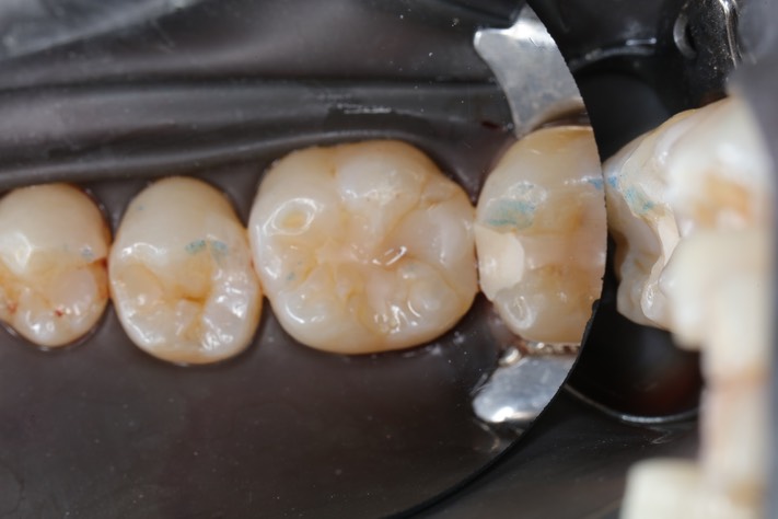 Matt Dodson #19 pre-op