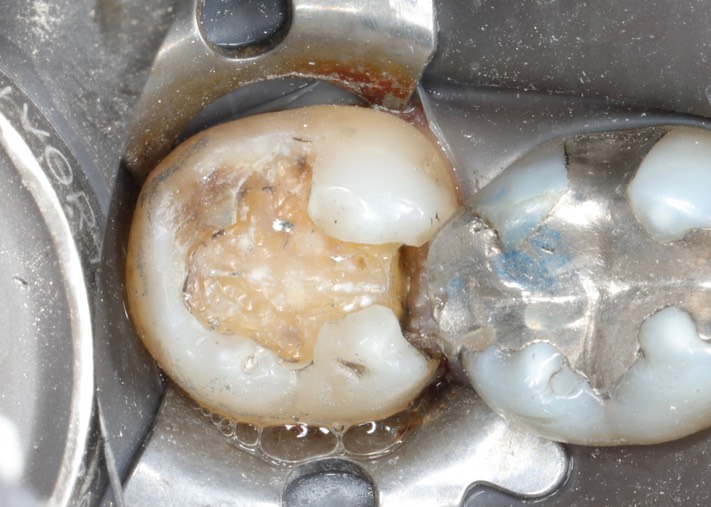 Matt Dodson #31 amalgam removal