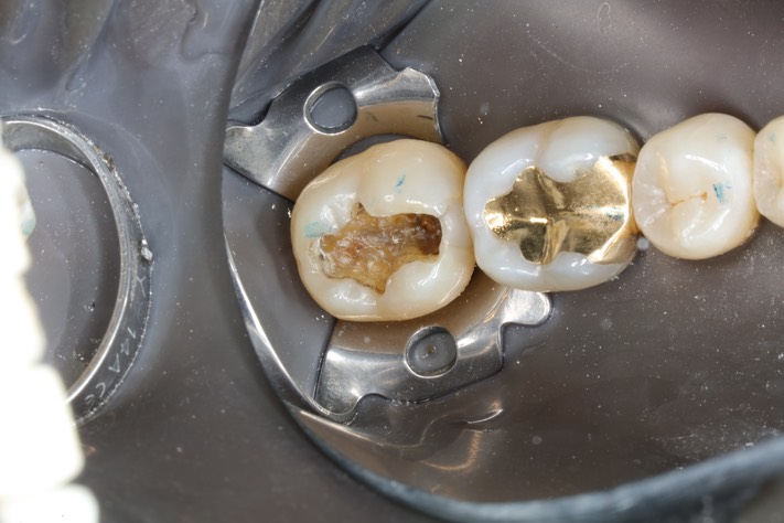 Matt Dodson #31 amalgam removal