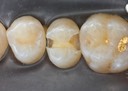 Matt Dodson #4 caries removal