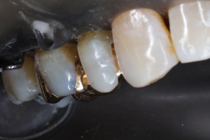 Matt Dodson #5 buccal view