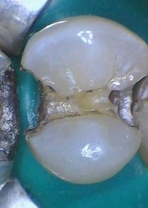 Mendel Sato #12 amalgam removal