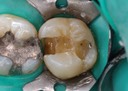 Mendel Sato #2 amalgam removal