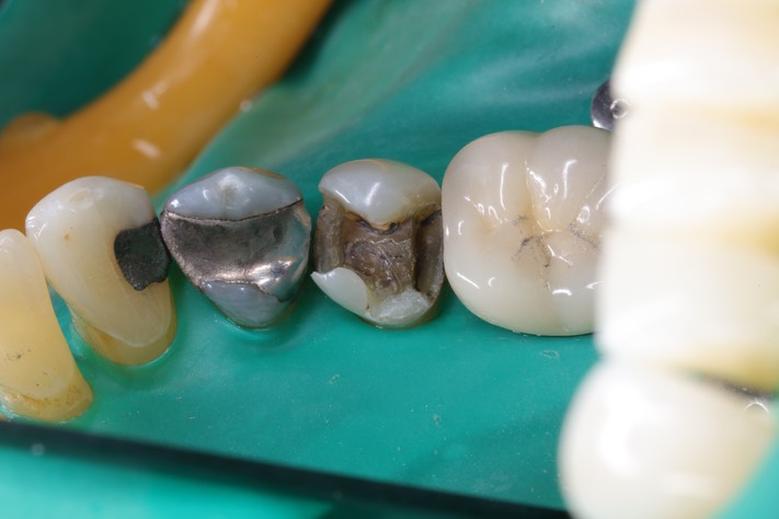 Mendel Sato #20 amalgam removal