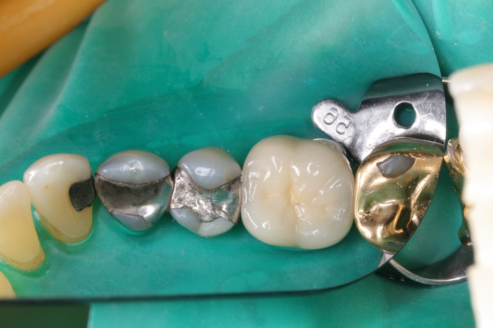 Mendel Sato #20 pre-op