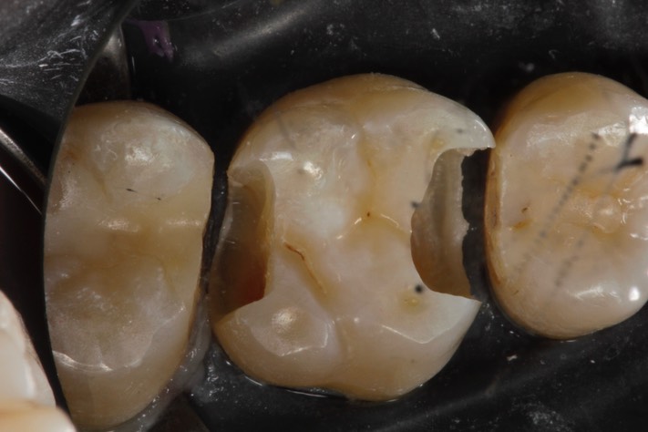 Mitchell Chun #14 caries removal