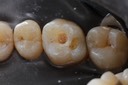 Mitchell Chun #3 amalgam removal
