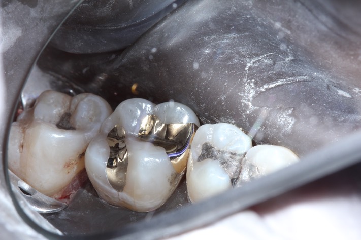 Nina Hayashi #14 lingual view