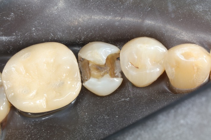 Russ Tabata #29 caries removal