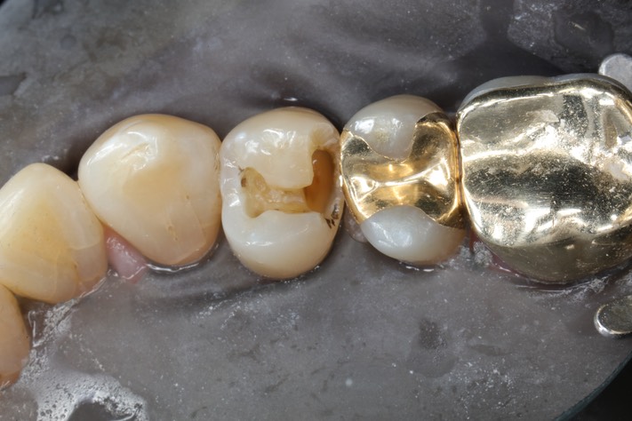 Russ Tabata #5 amalgam removal