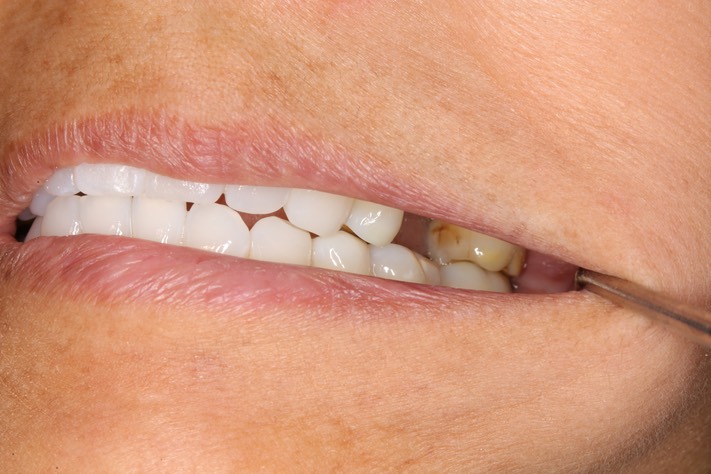 Scott Kanamori - left open bite