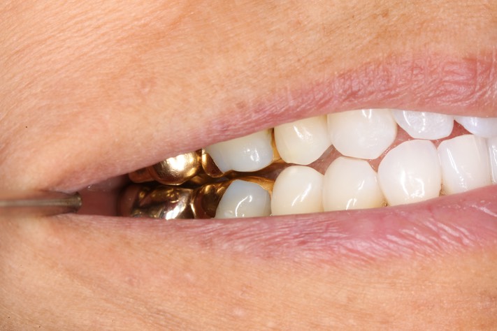 Scott Kanamori - right open bite