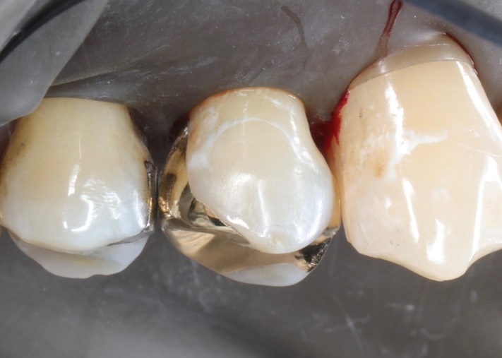 Scott Kanamori #12 buccal view