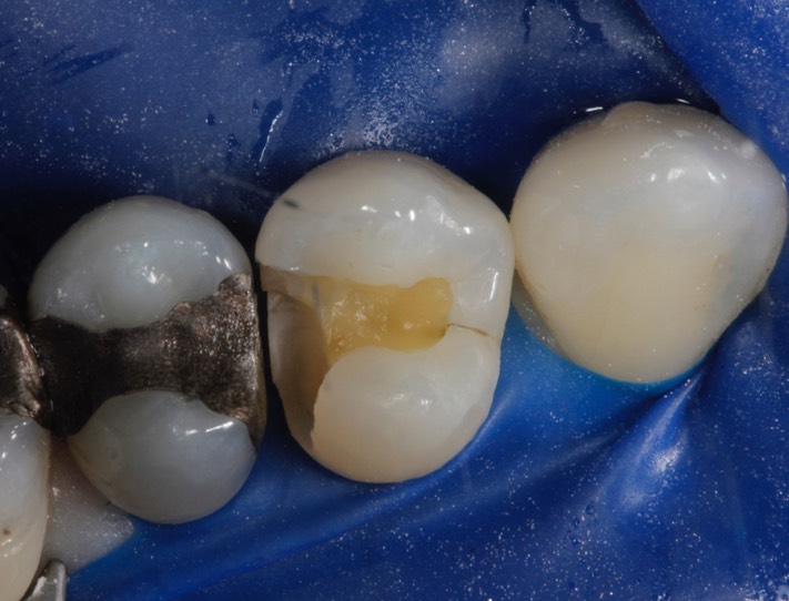 Scott Kanamori #12 caries removal