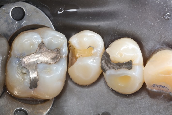 Scott Kanamori #13 amalgam removal