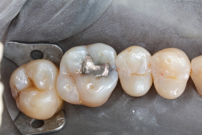 Scott Kanamori #14 pre-op