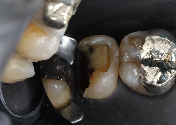 Scott Kanamori #15 composite removal