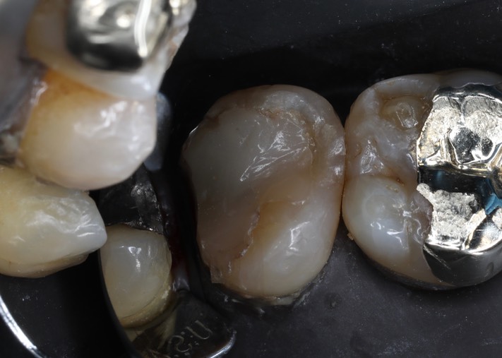 Scott Kanamori #15 pre-op