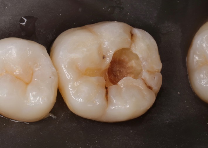 Scott Kanamori #19 caries removal 