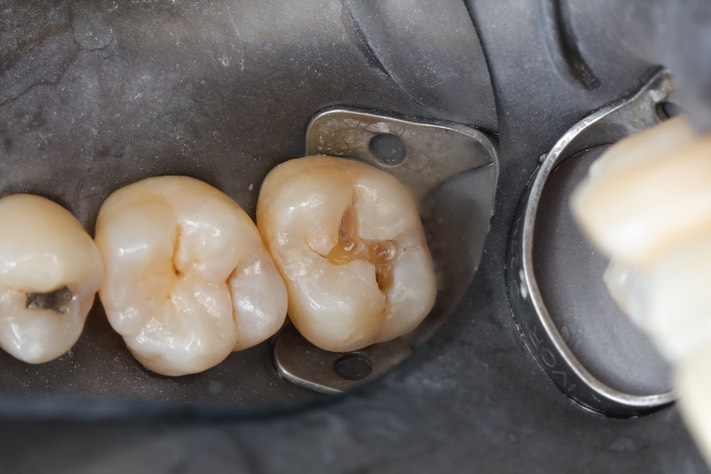 Scott Kanamori #2 amalgam removal