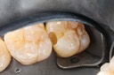 Scott Kanamori #2 caries removal