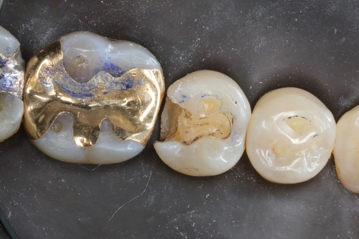 Scott Kanamori #29 amalgam removal